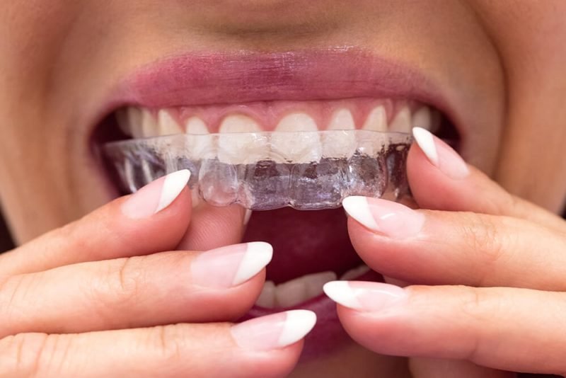 İNVİSALİGN (ŞEFFAF PLAK)